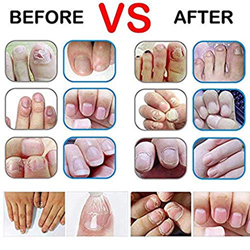 [Australia] - Euconychia Herbal Nail Treatment Pen Nail Repair Fingernails Toenails Rich Nutrition（2pcs) 