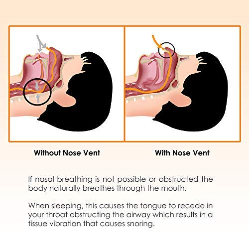 [Australia] - Nose Vent Sinus Relief Dilator (Pack of 12 XL Size) Hard Silicone Vents - A Simple Solution for Nasal Snorers - Reusable Snoring Device to Enjoy a Peaceful Night's Sleep by Mobi Lock 