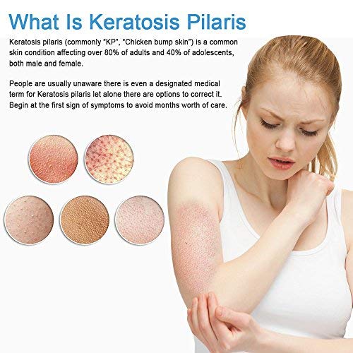 [Australia] - KP Essentials - Keratosis Pilaris Exfoliating Cream - Clear Red Bumps on Thighs and Arms For Confident Clear Skin - 4oz (1 Bottle) 4 Fl Oz (Pack of 1) 