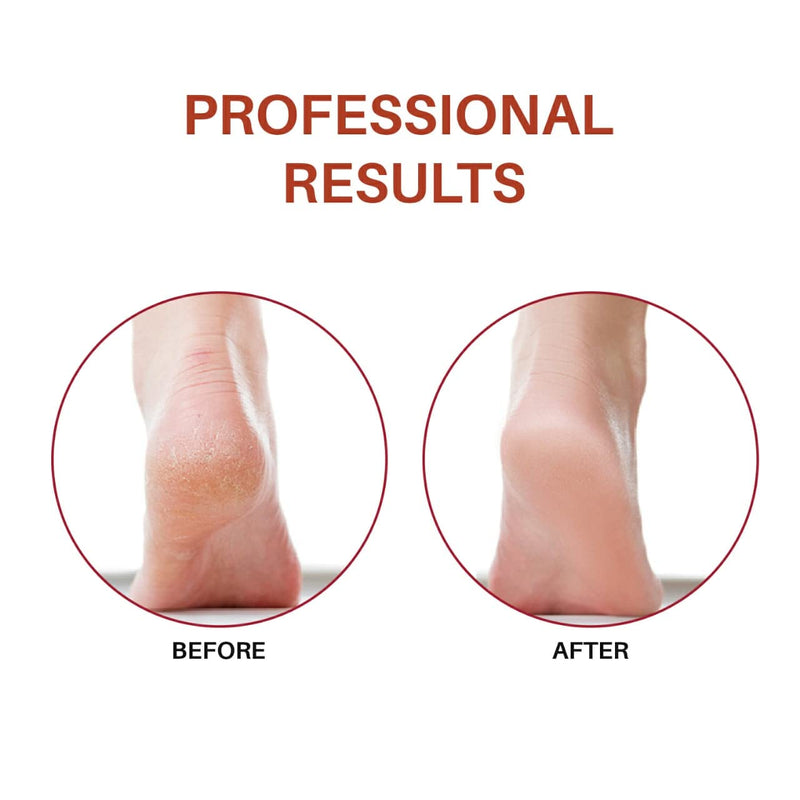 [Australia] - Foot Rasp Large Foot File And Callus Remover, Best Foot Care Pedicure Metal Surface Tool To Remove Hard Skin, Suitable On Both Wet And Dry Feet, Surgical Grade Stainless Steel File- Lifetime Warranty! 