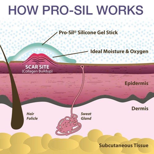 [Australia] - Pro-SIL Silicone Scar Treatment Stick - Patented, FDA Cleared, Clinically Proven to Reduce Scars - Glide-on Applicator, 4.25g, Made in USA 