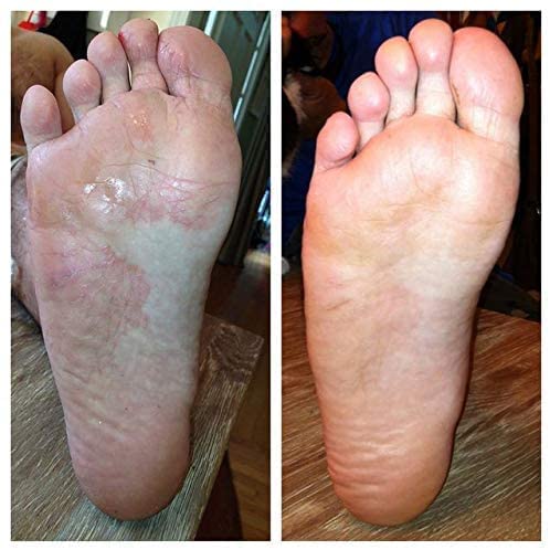 [Australia] - Shoe and Sock Spray for Fungal Nail Treatment | Athletes Foot & Anti Toe Nail Fungus Treatment | Ringworm Foot Care Shoe Freshener | 150 ML Imperial Feet 