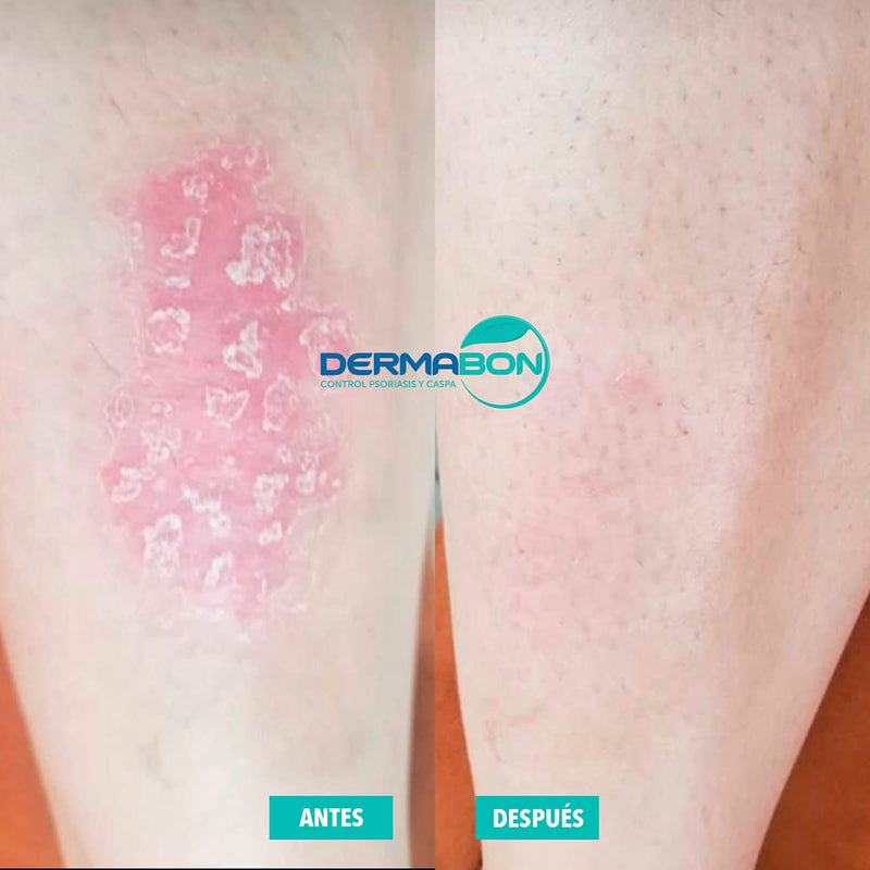 [Australia] - Crema Humectante y Jabón Para Dermatitis, Dermabon 