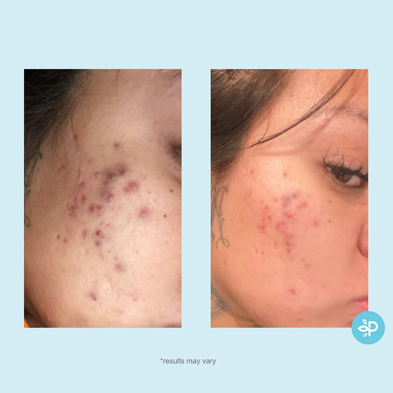 [Australia] - Salicylic 20% Gel Peel, Breakout and Pore Minimizer and Cleanser, Strength Level 2, 15-30 Full Facial Chemical Peels, 1 fl oz. e, 30 ml 