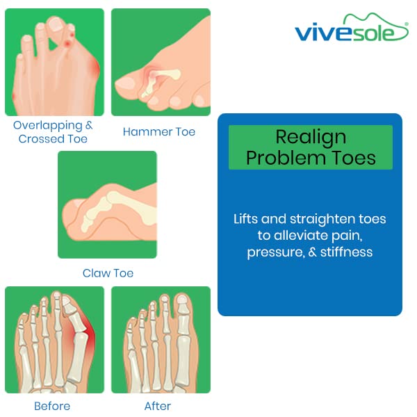 [Australia] - ViveSole Toe Straightener Splint [Pair] - Hammer Toe, Joint Realign Cushion Brace for Claw, Curled, Crooked Toe - Metatarsal Support Loop Guard Alignment Corrector Wrap for Tendon, Broken Toe Surgery 