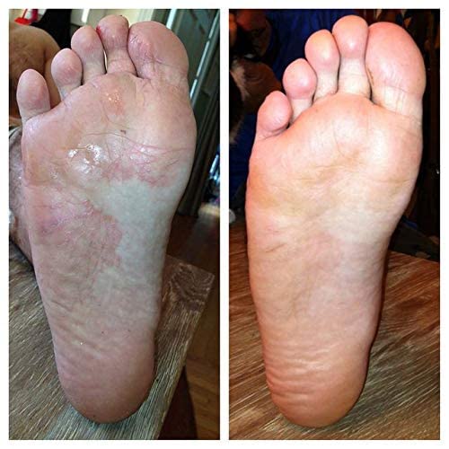 [Australia] - XL Athletes Foot Treatment Cream Extra Strength | Foot Fungus Cream and Toenail Fungus Treatment | Foot Cream Antifungal | Ringworm Foot Care | XL 75 ML 