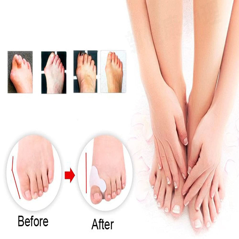 [Australia] - Dr.Pedi Bunion Corrector for Women Silicone Toe Separators for Overlapping Toes Women Correct Toes Straightener 1 Pair clear 