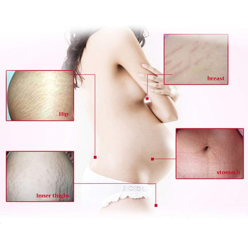 [Australia] - Scars Treatment, Anti-Stretch Cream Remove Stretch Marks Oil Stretch Marks Cream for Women Legs, Stomach Scars Removal Harden Cream 