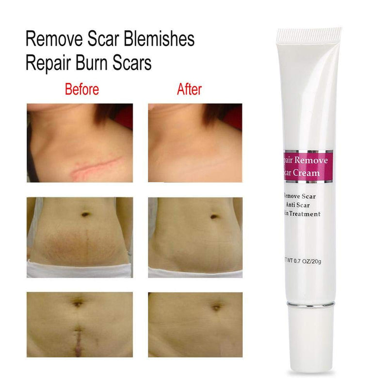 [Australia] - Scar removal cream, anti-scar cream for the relief of old scars and stretch marks and repair of burned skin, scar removal gel is suitable for skin care 