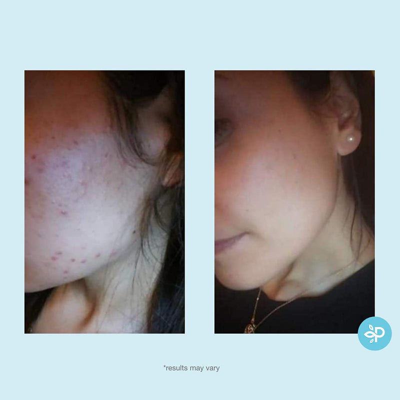 [Australia] - Salicylic 10% Gel Peel, Breakout and Pore Minimizer and Cleanser, 15-30 Full Facial Chemical Peels, 1 fl oz. e, 30 mL – Perfect Image 