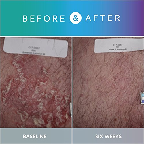 [Australia] - Prosoria Psoriasis Treatment System with Clinical Strength and Natural Botanical Ingredients - Treating, Softening and Restoring The Appearance of Skin, 2 Ounce 2 Fl Oz (Pack of 2) 