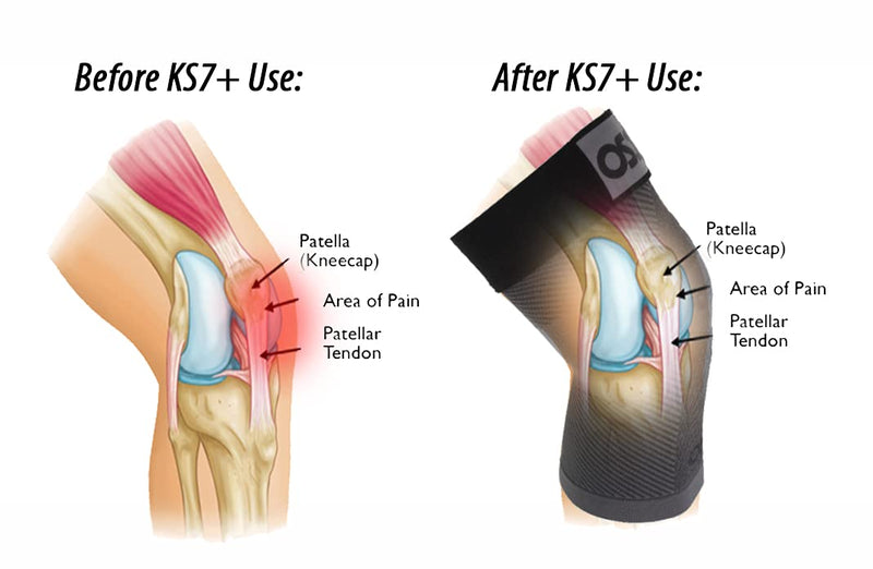 [Australia] - OrthoSleeve KS7+ Adjustable Knee Brace for perfect fit to relieve knee pain, tendonitis pain, swelling and reduce inflammation. X-Large 