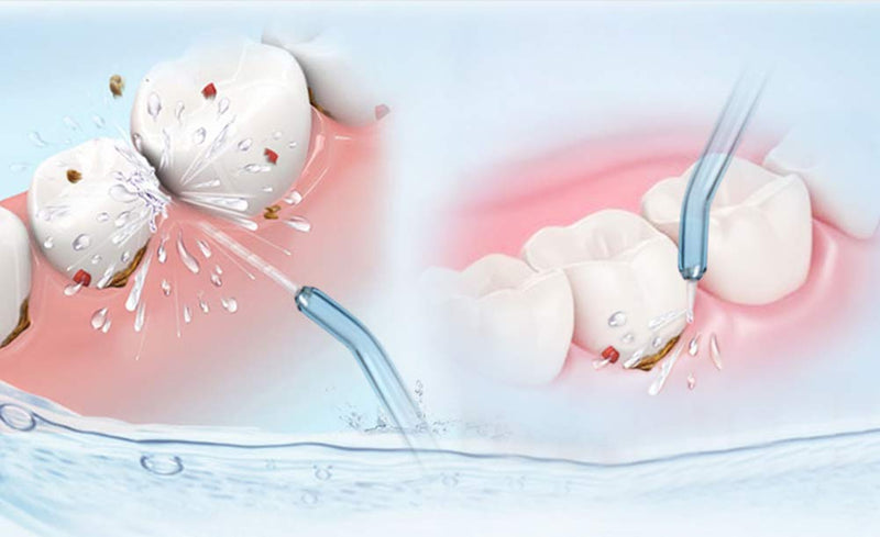 [Australia] - YanBan 2pcs Dental Water Jet Tips Refills for Waterpik, Replacement Dental Water Oral Irrigator for WP-100, WP-250, WP-300, WP-450, WP-660, WP-900 