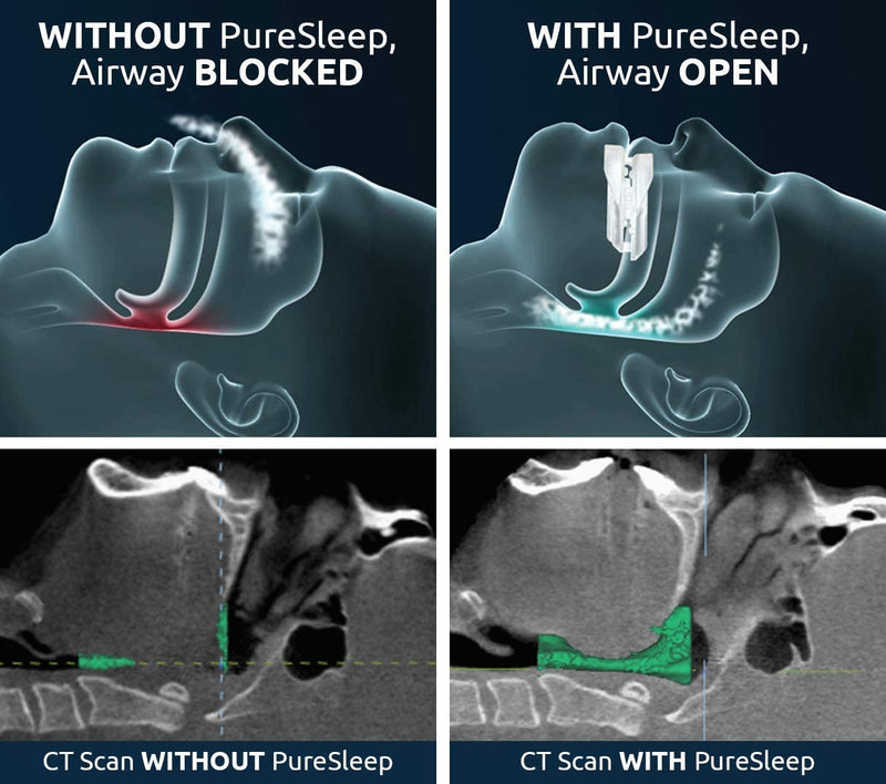 [Australia] - PureSleep Anti-Snoring Mouthpiece – Helps Stop Snoring – The Original Anti-Snoring Solution – Comfortable & Adjustable – Over a Million Units Sold – Made in The USA 