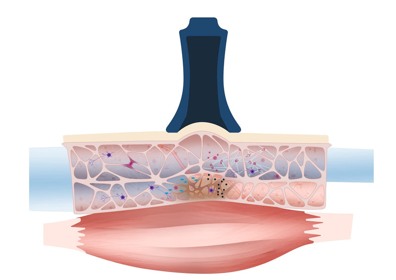 [Australia] - BellaBambi¬Æ cupping bell, fascia treatment Made in Germany - made of medical silicone, BellaBambi Cupping Solo, 1 piece - INTENSE - Ruby Red (high intensity) 1020194 