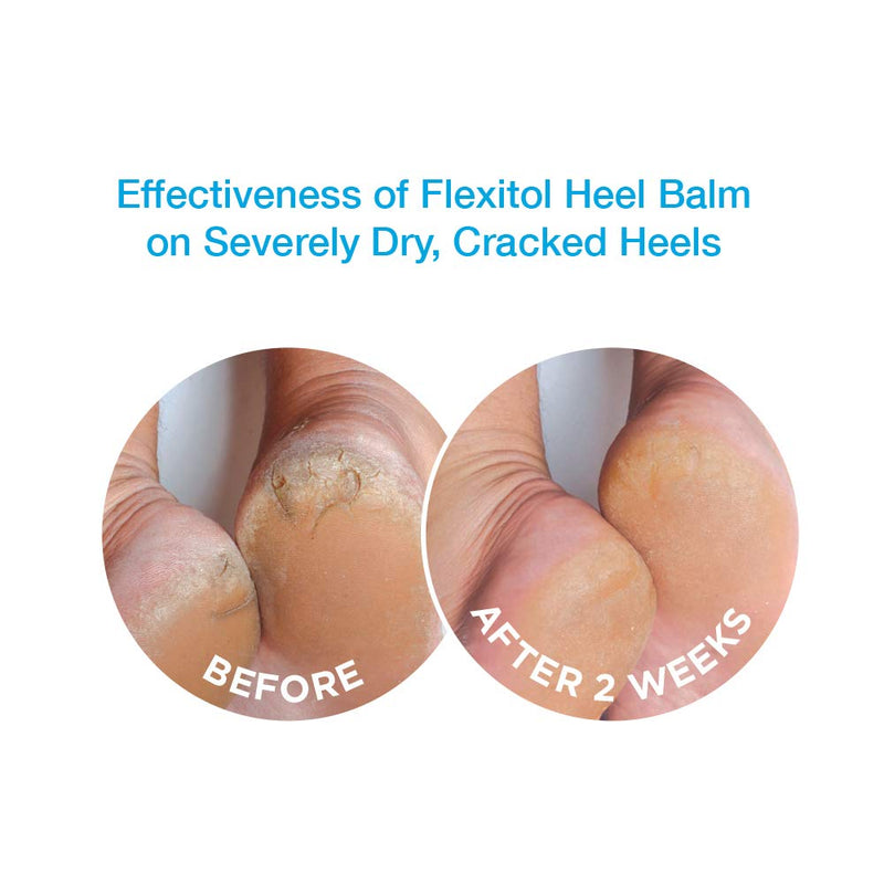[Australia] - Flexitol Heel Balm 4 Oz Tube (Pack of 2), Rich Moisturizing & Exfoliating Foot Cream. Fast Relief of Rough, Dry & Cracked Skin on Heels/Feet. For Daily Use and Pedicures. Diabetic Safe and Effective 4 Ounce (Pack of 2) 