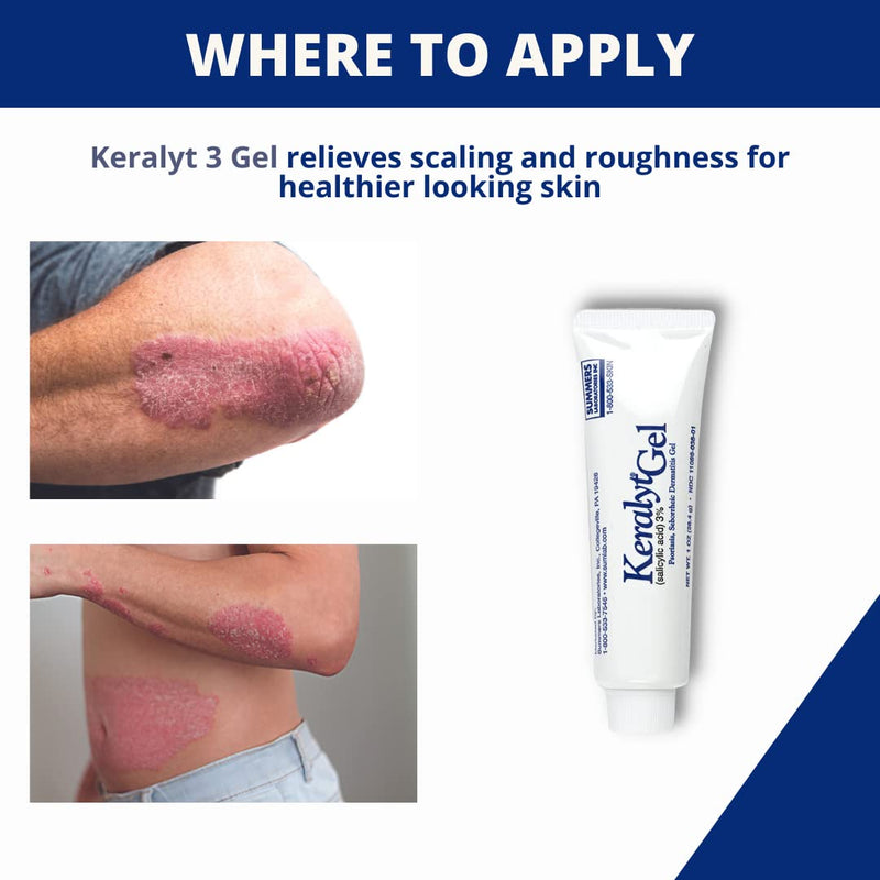 [Australia] - Keralyt 3% Salicylic Acid Gel - Exfoliating Moisturizing Skin Gel - Promotes Relief from Itchy, Redness, Dryness, Roughness, and Flakey Skin from Psoriasis, Eczema, Acne, Dermatitis 3% Gel 