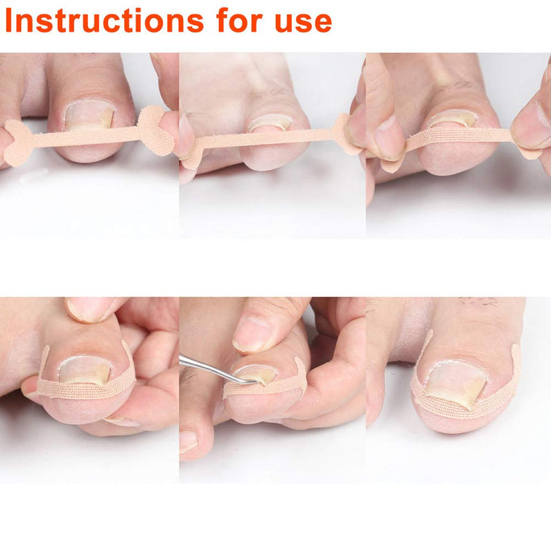 [Australia] - Ingrown Toenail Correction Sticker, 24pcs Paronychia Treatment Band Sticker Toenail Correction Bandage Foot CareTool for Pain Relief 