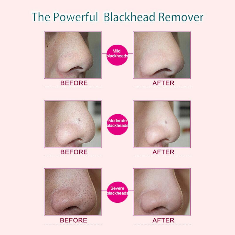 [Australia] - Blackhead Remover Pore Vacuum with 6 Probes, Microdermabrasion Blackhead Extractor Tool (Blackhead Remover) white 