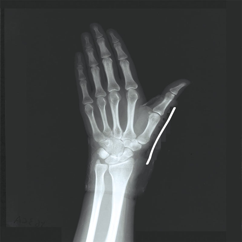 [Australia] - LP Extreme Wrist and Thumb Support, Wrist Support for Pain Relief, Sprains & Prevents De Quervain Disease, Black - One Size 