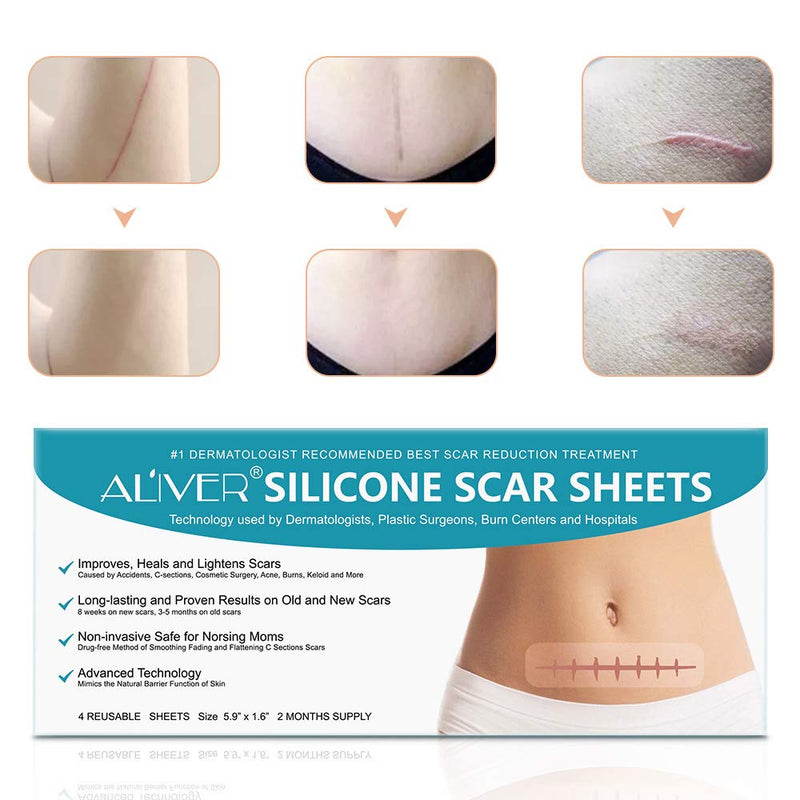 [Australia] - Silicone Scar Sheets, IFUDOIT 4 Sheets Reusable Silicone Scar Removal Sheets, Effectively Repair Scars Resulting from Surgery, Injury, Burns, Acne, C-Section 1 Pcs 