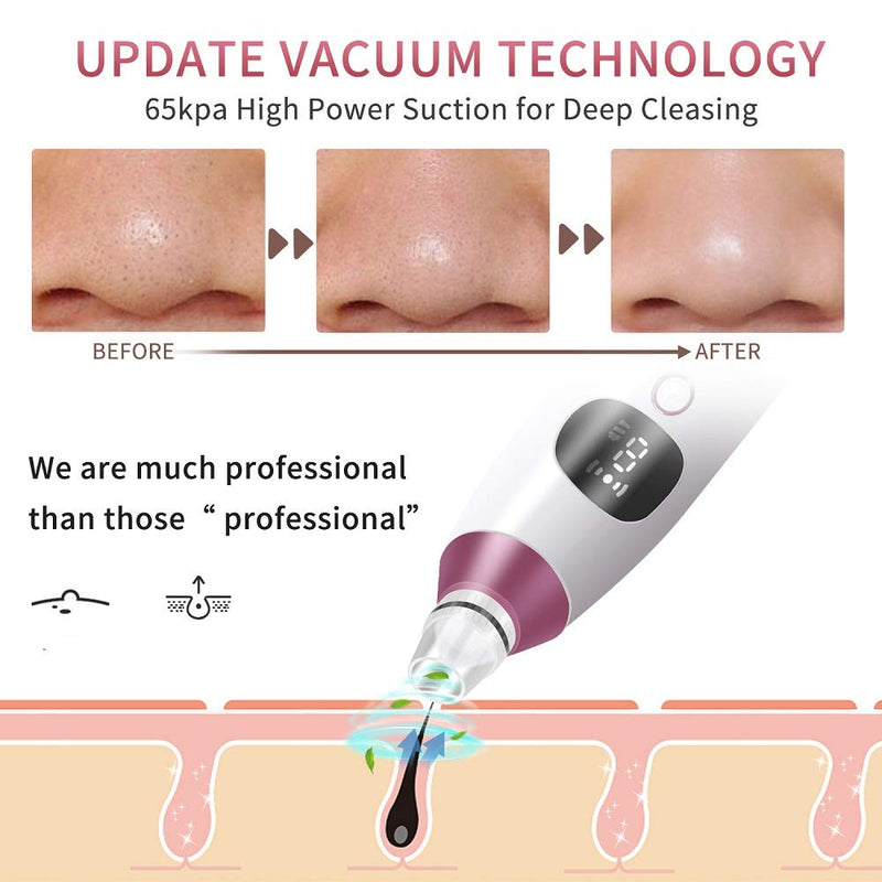 [Australia] - Blackhead Remover Vacuum (Pink) Pink 