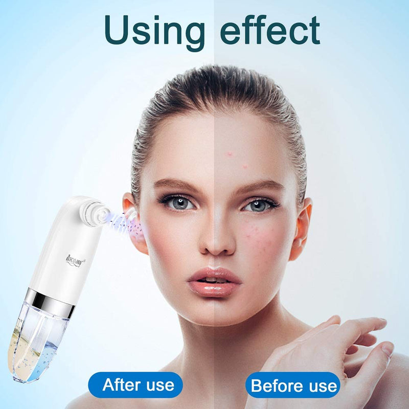 [Australia] - Blackhead Remover Vacuum with water cleaning Pore Vacuum to avoid drying pore care for deep cleasing with 6 suction heads & 3 suction levels USB rechargeable Unisex (Blue) Aicomy Blue 