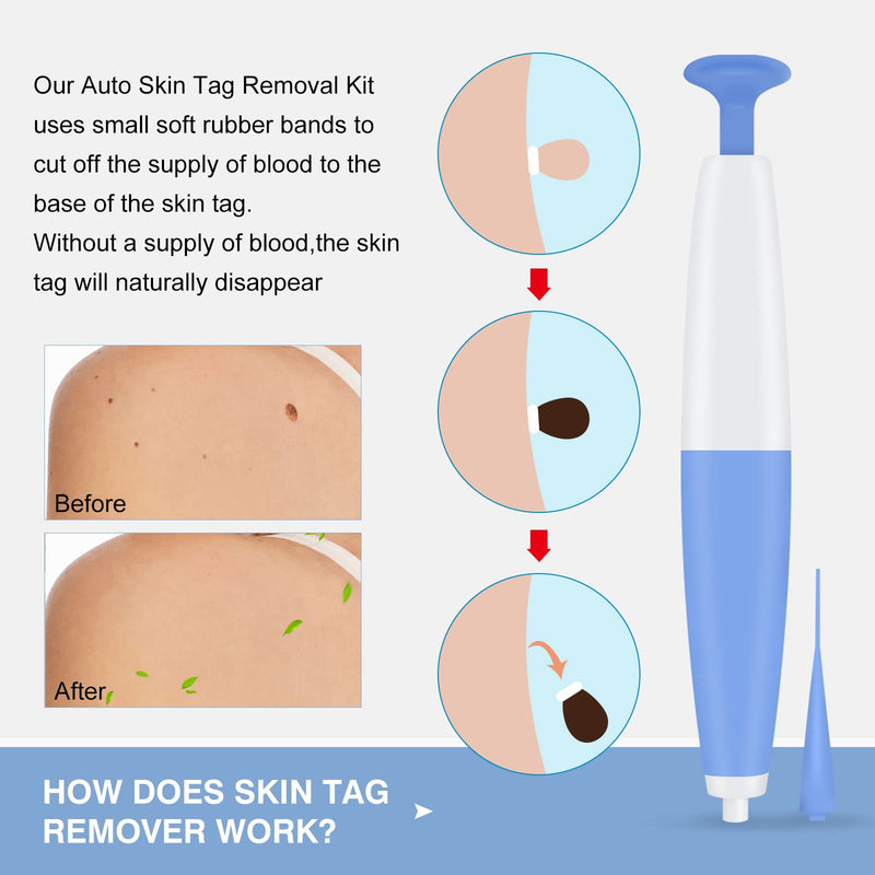 [Australia] - Memonotry Skin Tag Remover, Skin Tag Removal Kit Tools with 40Pcs Repair Patches for Micro to Small Skin Tags, Easy Application Device to Remove Skin Tags 5 