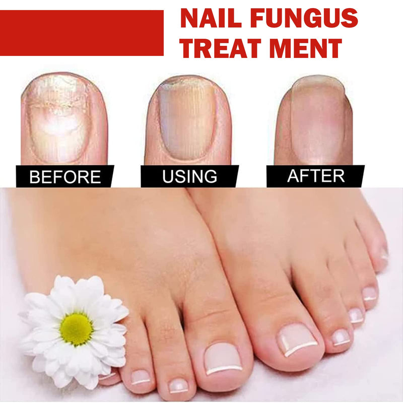 [Australia] - Nail Care Solution,Anti fungal Nail Solution,Nail Fungus Solution,Fungal nail,Nail Fungus Fungus Stop,Restores Appearance of Discolored 