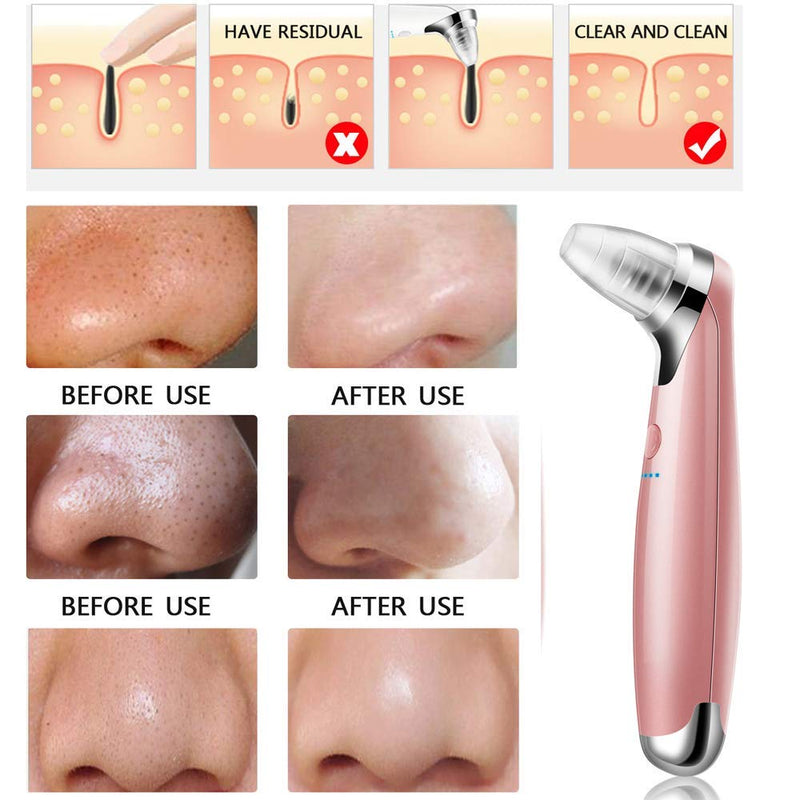 [Australia] - Electric Blackhead Remover Vacuum, Blackhead Remover Tool, 5-Speed Adjustment and 5 Suction Head with Beauty Lamp Treatment for Facial Skin (Pink) Pink 
