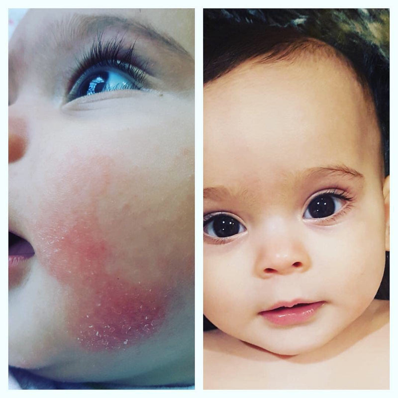 [Australia] - Bria 100% Natural Organic Soothing Balm for Eczema Prone & Dry Skin Suitable for Adults, Children & Babies – Scent Free (60ml) 60 ml (Pack of 1) 