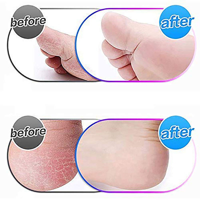[Australia] - Mineral Replacement Rollers, 10 Pack Head Replacement Compatible With Emjoi Micro Callous Remover For Extremely Rough And Tough Skin… 