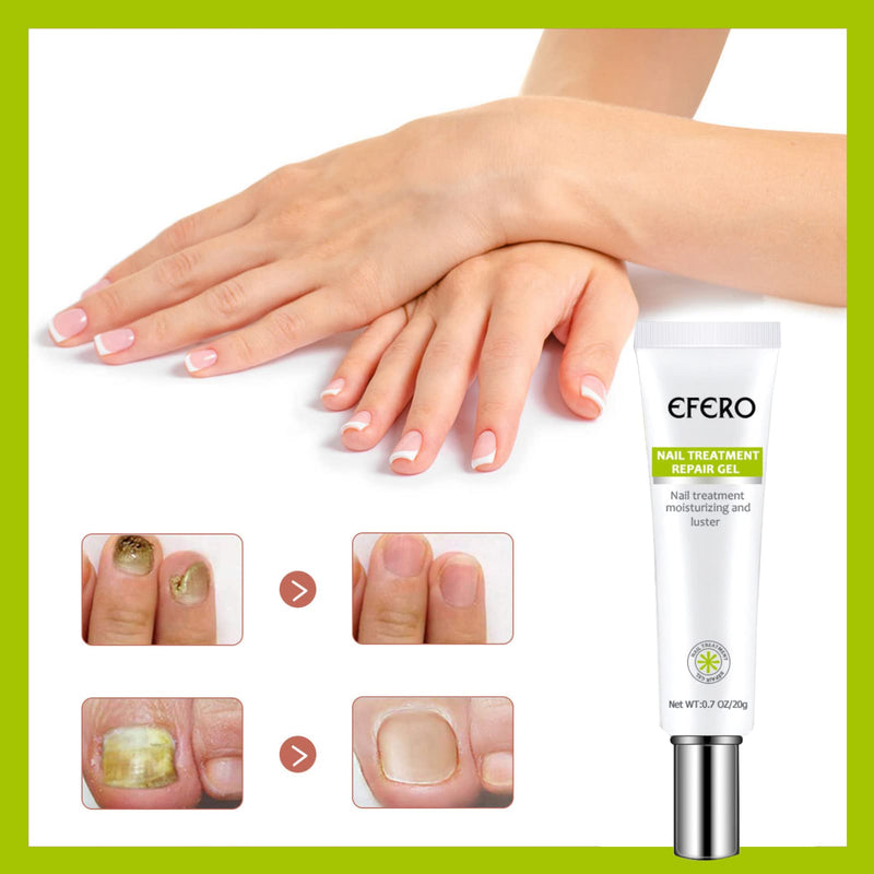 [Australia] - Fungal Nail Treatment, Fungus Nail Cream, Fungal Nail Eliminator for Toenails and Fingernails Strong Anti-Fungal Toenail Cream, Nail Repair Nourishing Treatment 