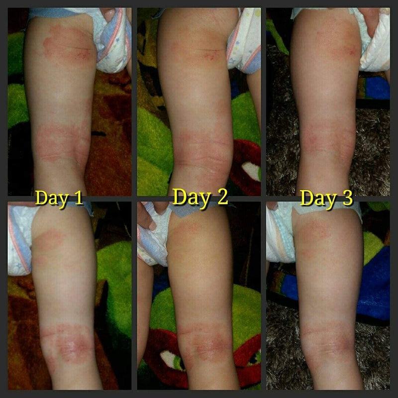 [Australia] - Soothe My Skin Cream for Sensitive Skin - Eczema Cream Psoriasis Atopic Dermatitis Lichen Sclerosus. Emu Oil Cream with Only Natural Ingredients 