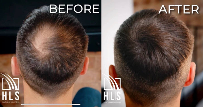 [Australia] - HLS (Hair Loss Solutions) - Hair Fibres, Instantly Conceals Thinning and Balding Hair. Our HLS Hair Powder is Undetectable and is an Instant Hair Thickener, Hair Fibers 25g (Auburn) Auburn 