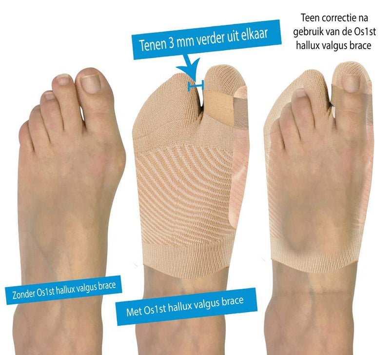 [Australia] - OS1st HV3 Bunion Brace (One Sleeve) Toe Straightener, Splint for Foot Bunion Pain/Hallux Valgus Relief Large/X-Large 