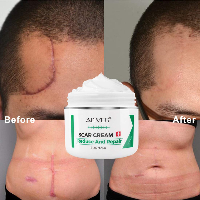 [Australia] - Scar Removal Cream for New Scars, Scar Treatment for Stretch Mark, Skin Repair Cream for Face Body Scar, Acne Spots, C-Sections, Burn, Acne, Stretch Marks 