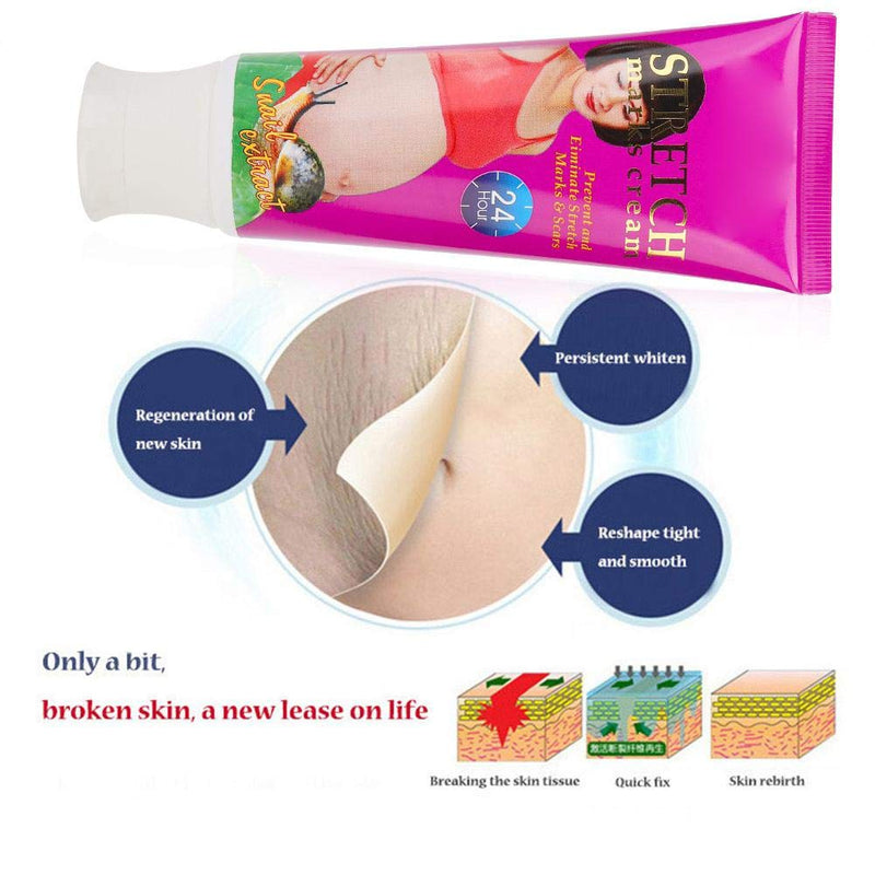 [Australia] - Scars Treatment, Anti-Stretch Cream Remove Stretch Marks Oil Stretch Marks Cream for Women Legs, Stomach Scars Removal Harden Cream 