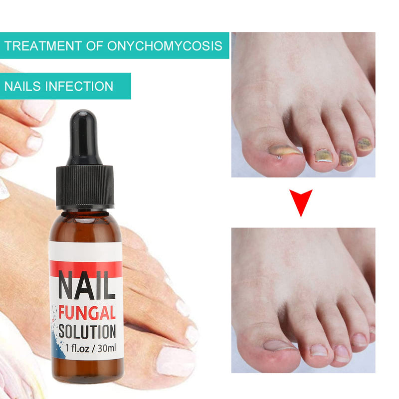 [Australia] - Fungal Nail Renewal, Multi-Purpose Nail Repair, Nail Fungus Treatment Toenail Fungus Treatment Fungal Health Care Solution for Finger Toenail Fungus Athlete's Foot 