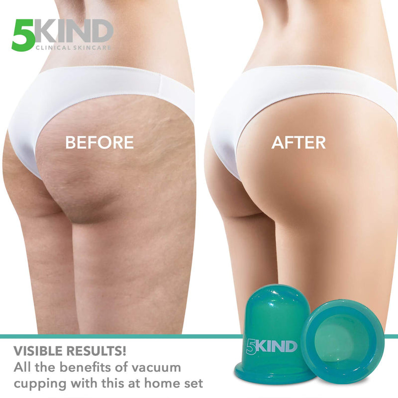 [Australia] - 5kind clinical skincare Anti-Cellulite Cup Set with Instructions, Satin Bag, Free e-Book and Discount Voucher for 5kind Professional Cellulite Cream 