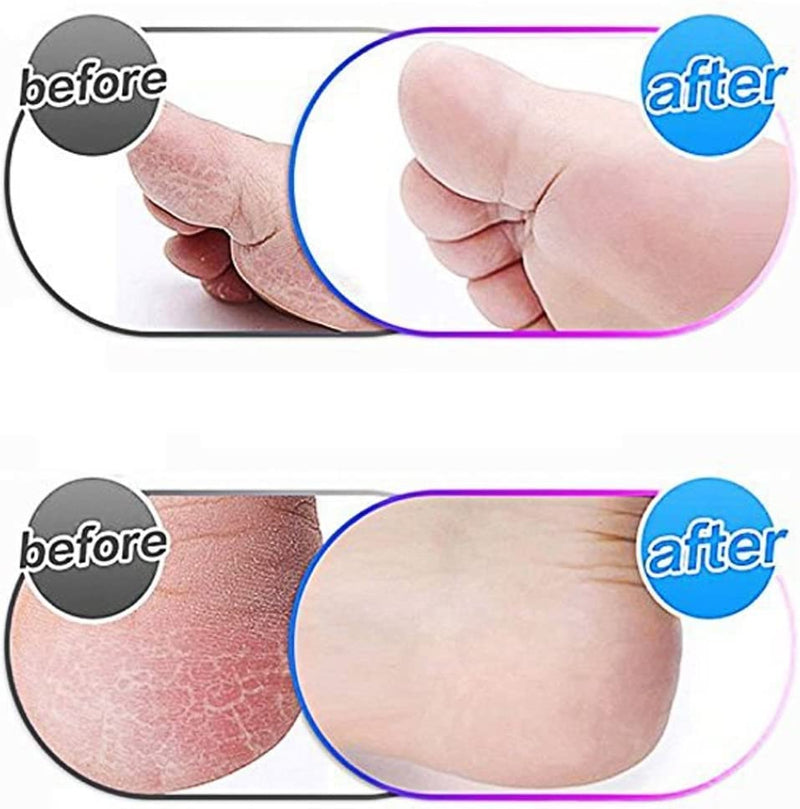 [Australia] - 5 Pcs Rollers for Electric Foot File, Pedicure Hard Skin Remover Refills, Coarse Replacement Roller Compatible with Emjoi Micro Pedi Nano 