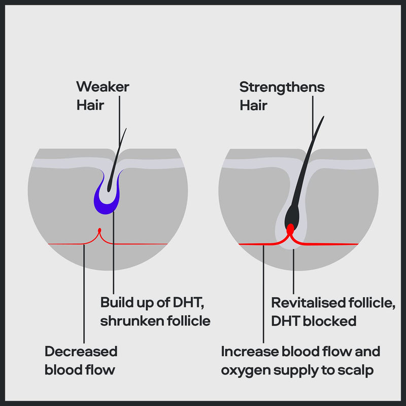 [Australia] - Sons Complete Hair Loss Treatment 1 Month - Minoxidil, Biotin & Shampoo - Boosts Thick Hair Regrowth 