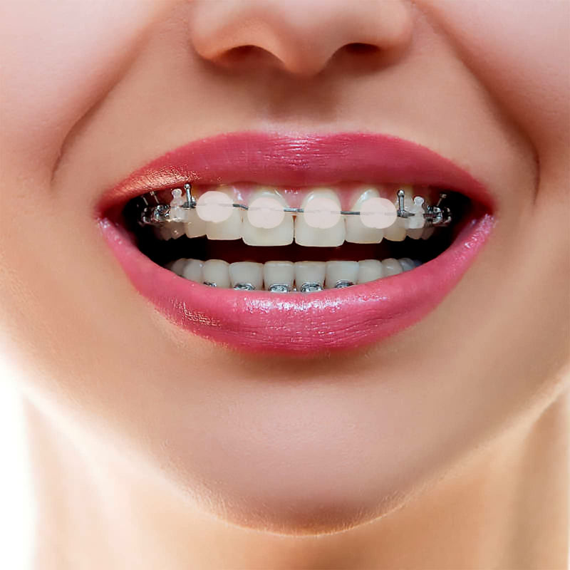 [Australia] - MIBICIRI 6 Boxes Dental Wax for Braces, Dental Cement Orthodontic Care Kits for Braces Protection Pain Relief (Mint Scent) Mint Scent 