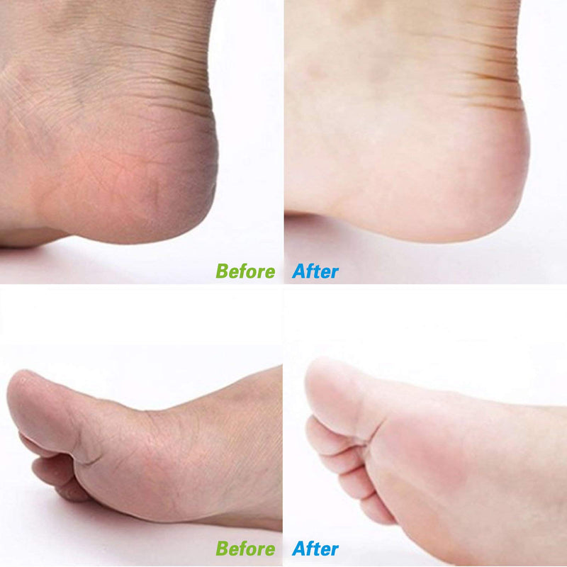 [Australia] - Foot File, Callus Remover Surgical Steel Dual-Sided Foot Rasp Pedicure for Feet Care Hard Skin Remove 