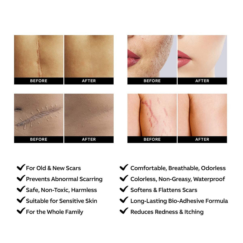 [Australia] - AZALLY Advanced Scar Gel - Scar Diminishing Serum - Reduces The Appearance of Old & New Scars - Best Scar Treatment for Repair Scars from Burns Cuts Acne Spots Stretch Marks 