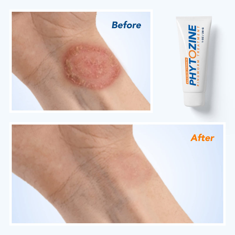 [Australia] - PHYTOZINE Ringworm Cream - Treats Stubborn Ringworm Infections, Fights Ringworm On Skin, Anti-Fungal Tolnaftate, Powerful Topical Treatment (1 Ounce) 1 Ounce (Pack of 1) 