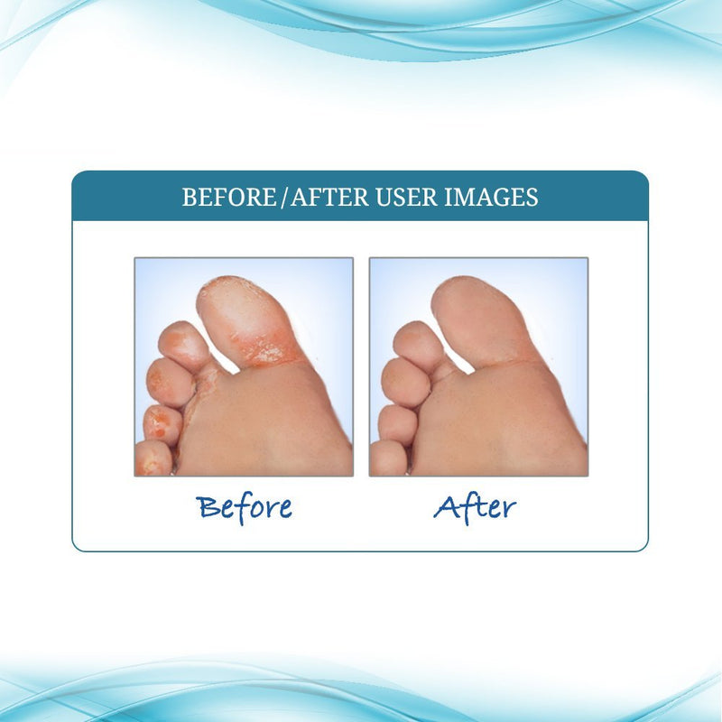 [Australia] - FUNGINIX AF Athletes Foot Cream - Topical Anti-Fungal Treatment, Eliminates Athlete's Foot Infections, Safe & Effective (3 Tubes) 3 