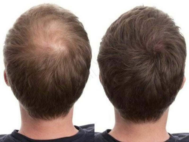 [Australia] - 100% Natural Keratin Hair Fibre Refill For Hair Loss - Alopecia & Chemotherapy (100g, Black) 100 g (Pack of 1) 