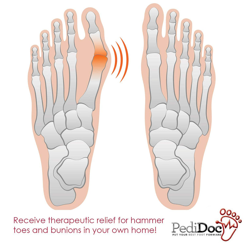 [Australia] - Bunion Corrector Bunion Toe Straightener – Bunion Relief Big Toe Strap Bunion Splint Restores Natural Alignment of Overlapping and Crooked Toes – Big Toe Spacer and Toe Stretcher 
