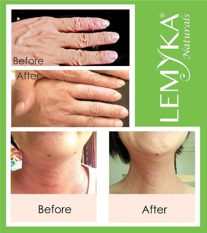 [Australia] - Eczema cream for dry itchy skin, LEMYKA 10X organic plant actives & ceramides for atopic dermatitis, face & eyelid rash, hives - Fast relief for baby, kids and adults 